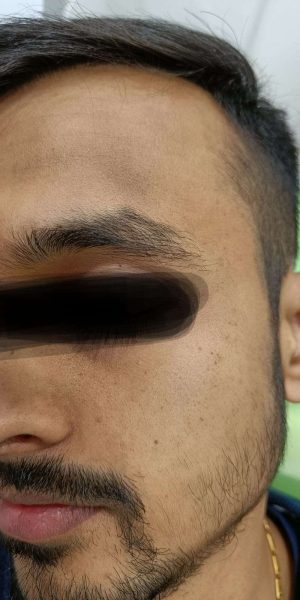 Best Skin treatment Clinic in Pune